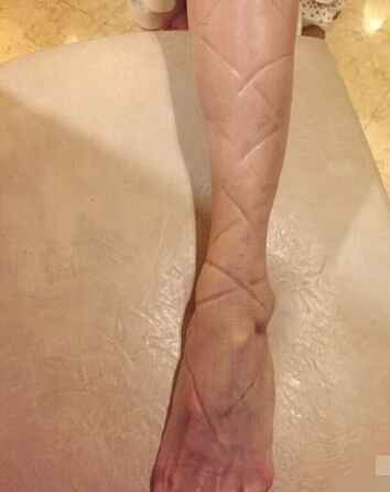 孙燕姿晒腿照勒痕复杂交错 不忍直视